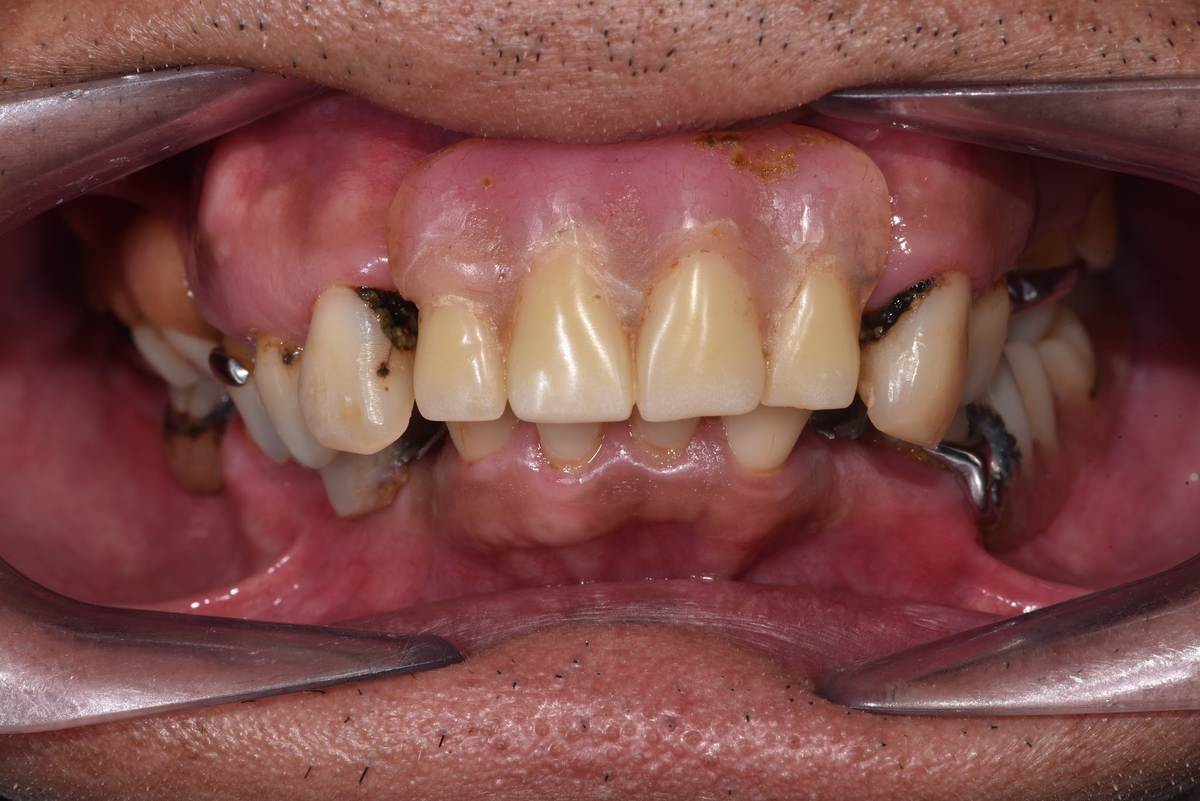 Chú Peter Hồng (Việt kiều Úc) – quá trình điều trị Hình: Chú Peter Hồng (Việt kiều Úc) – quá trình điều trị