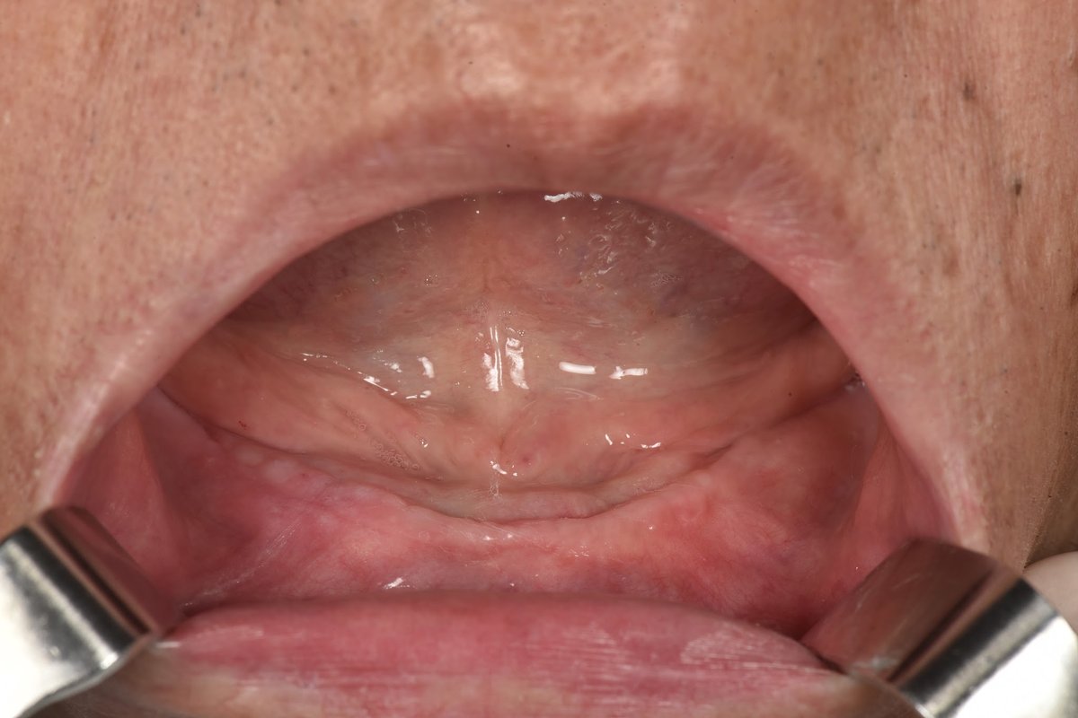 Hình: Chú Phạm Đức Nguồn – tình trạng trước điều trị