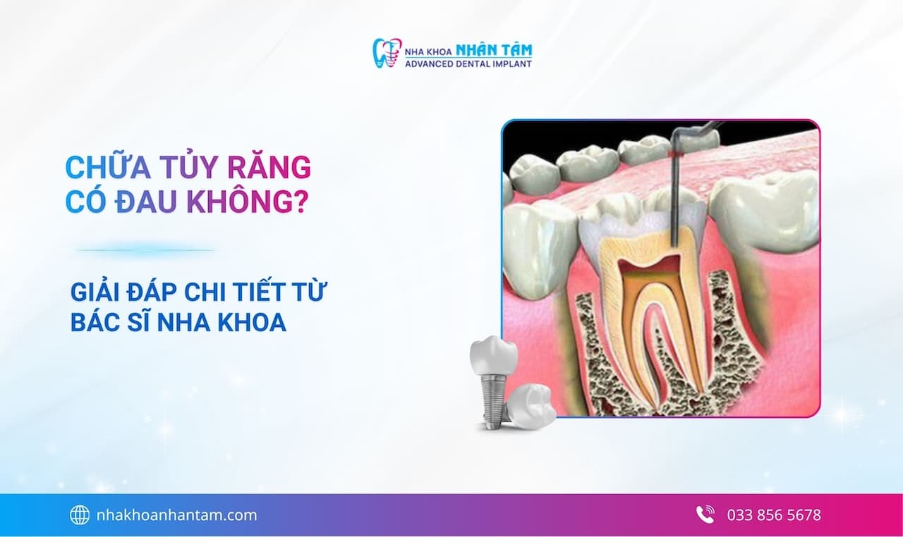 Chữa tủy răng có đau không? Giải đáp chi tiết từ bác sĩ nha khoa