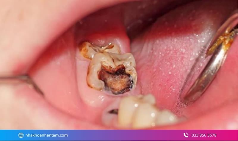 chữa tủy răng có nhức không