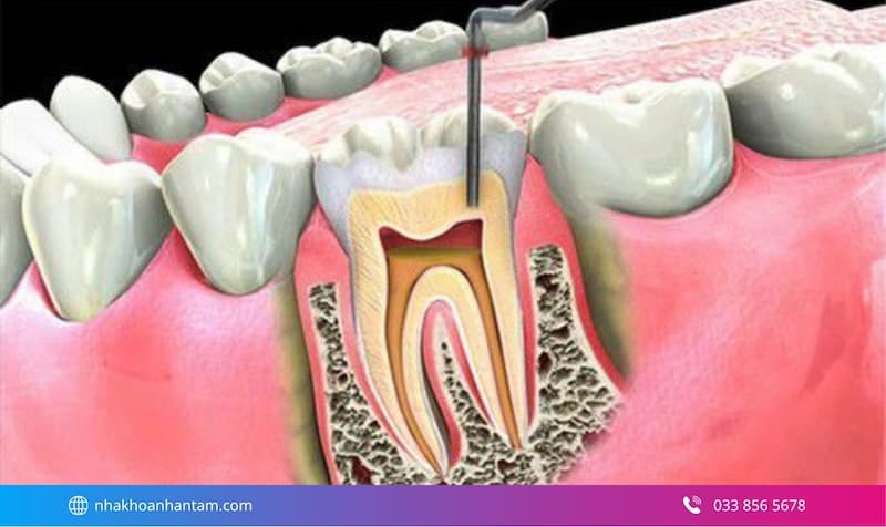 điều trị tủy răng có đau không