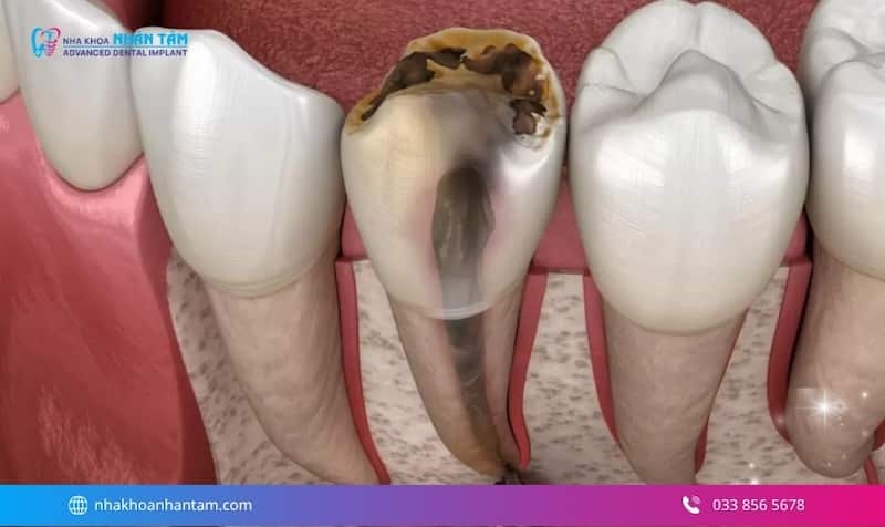 chữa tủy răng hết bao nhiêu tiền