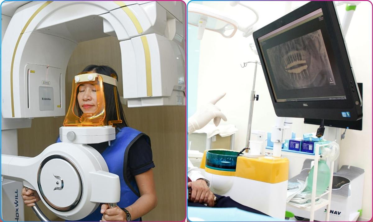 Hình: Trước khi cấy Implant bạn cần chụp phim CT 3D để kiểm tra tình trạng răng hàm
