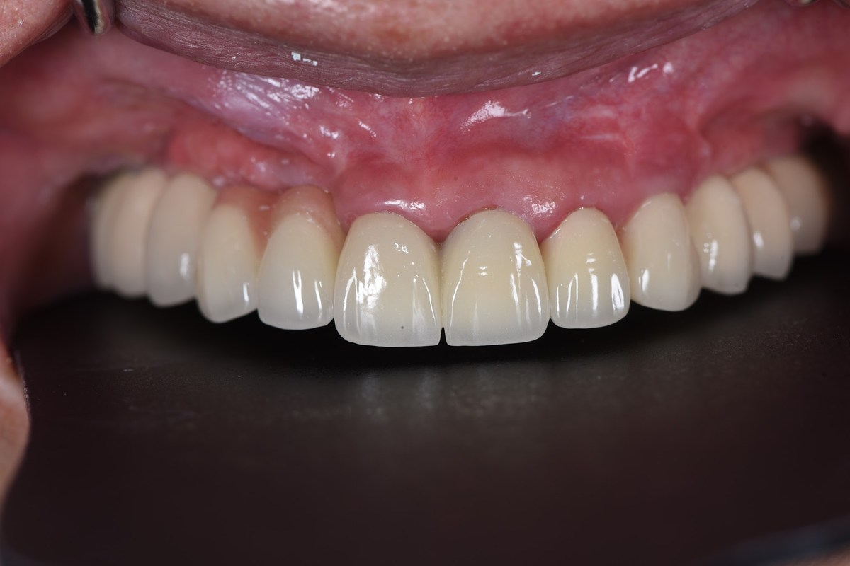 Cô Huệ (Việt kiều Mỹ) – kết quả sau điều trị Hình: Cô Huệ (Việt kiều Mỹ) – kết quả sau điều trị