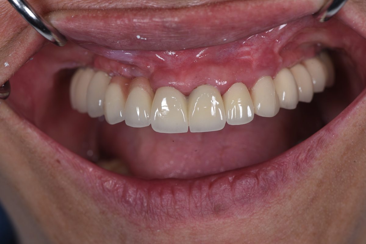 Cô Huệ (Việt kiều Mỹ) – quá trình điều trị Hình: Cô Huệ (Việt kiều Mỹ) – quá trình điều trị