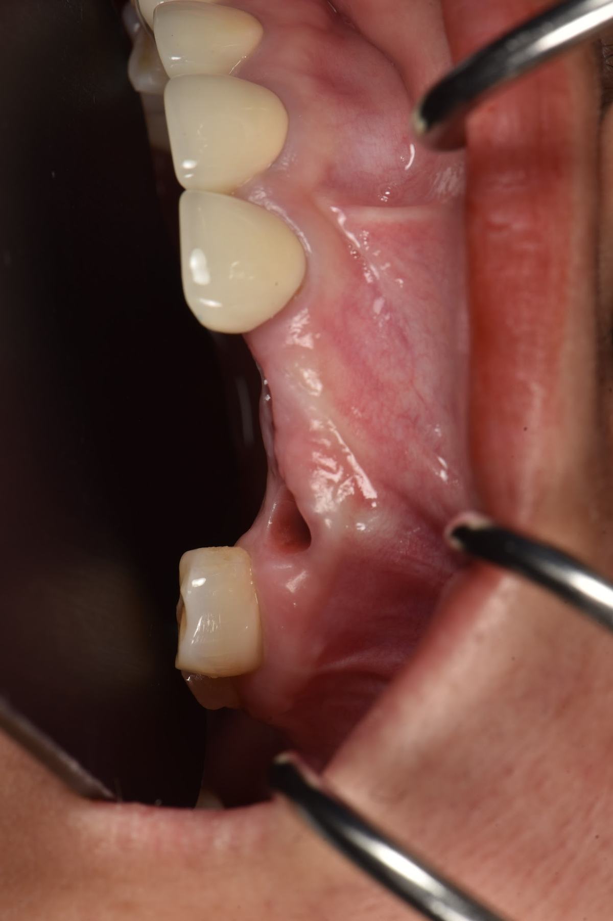 Hình: Cô Huỳnh Bông Lai – tình trạng trước điều trị