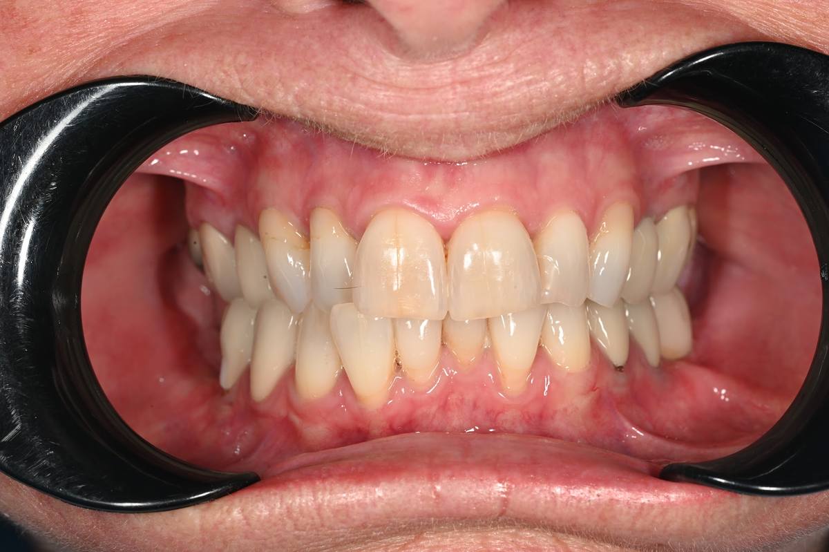 Hình: Cô Judith Burridge (Úc) – kết quả sau điều trị