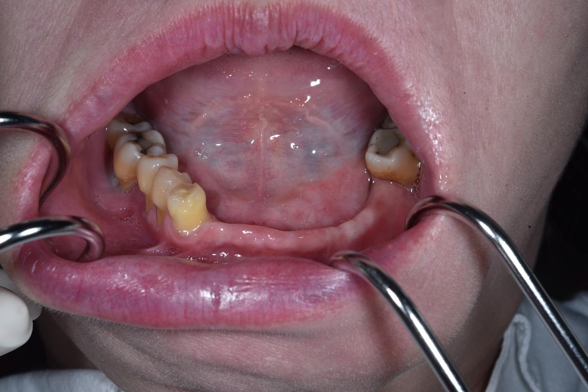 Hình: Cô Nguyễn Thị Kim Liên – tình trạng trước điều trị