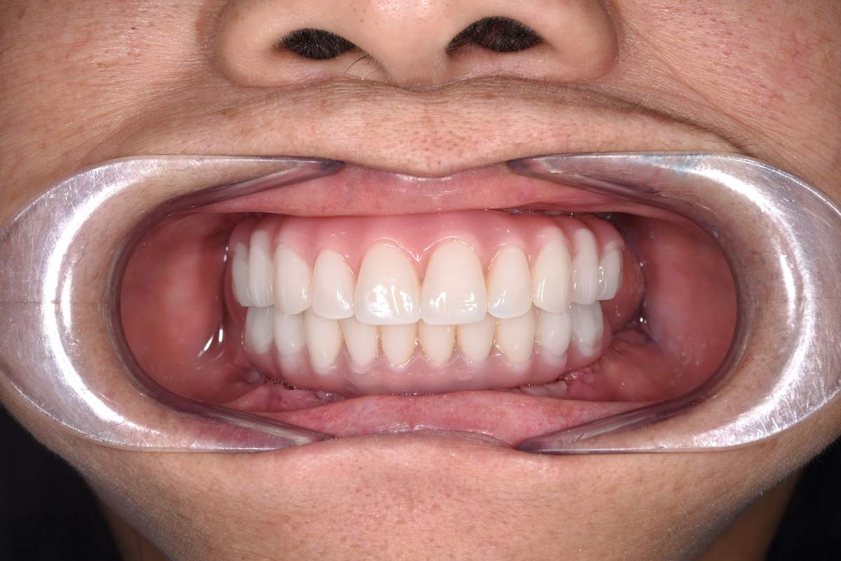 Hình: Cô Nguyễn Thị Thanh Bình (Việt kiều Mỹ) – quá trình điều trị