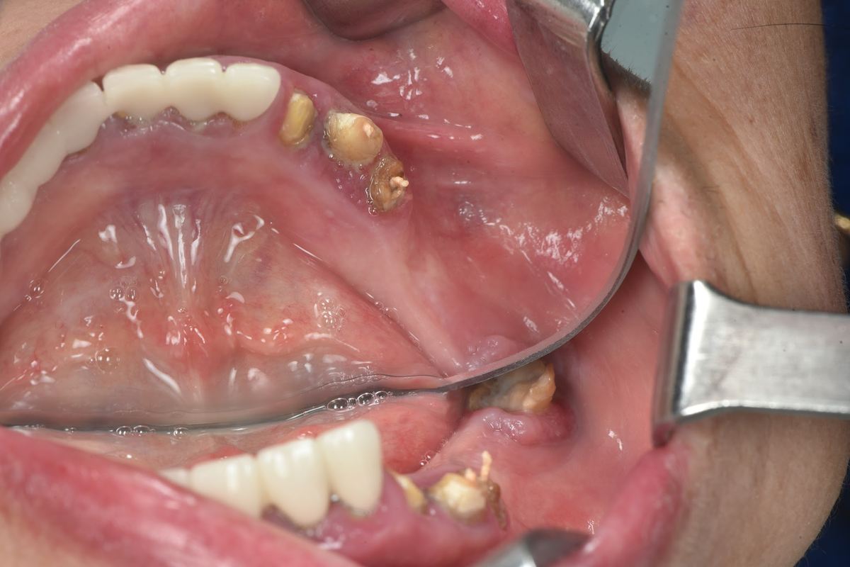 Hình: Cô Nguyễn Thị Thanh Bình (Việt kiều Mỹ) – tình trạng trước điều trị