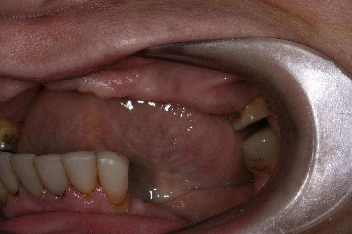 Cô Nguyễn Thị Vàng (Việt kiều Úc) – tình trạng trước điều trị Hình: Cô Nguyễn Thị Vàng (Việt kiều Úc) – tình trạng trước điều trị