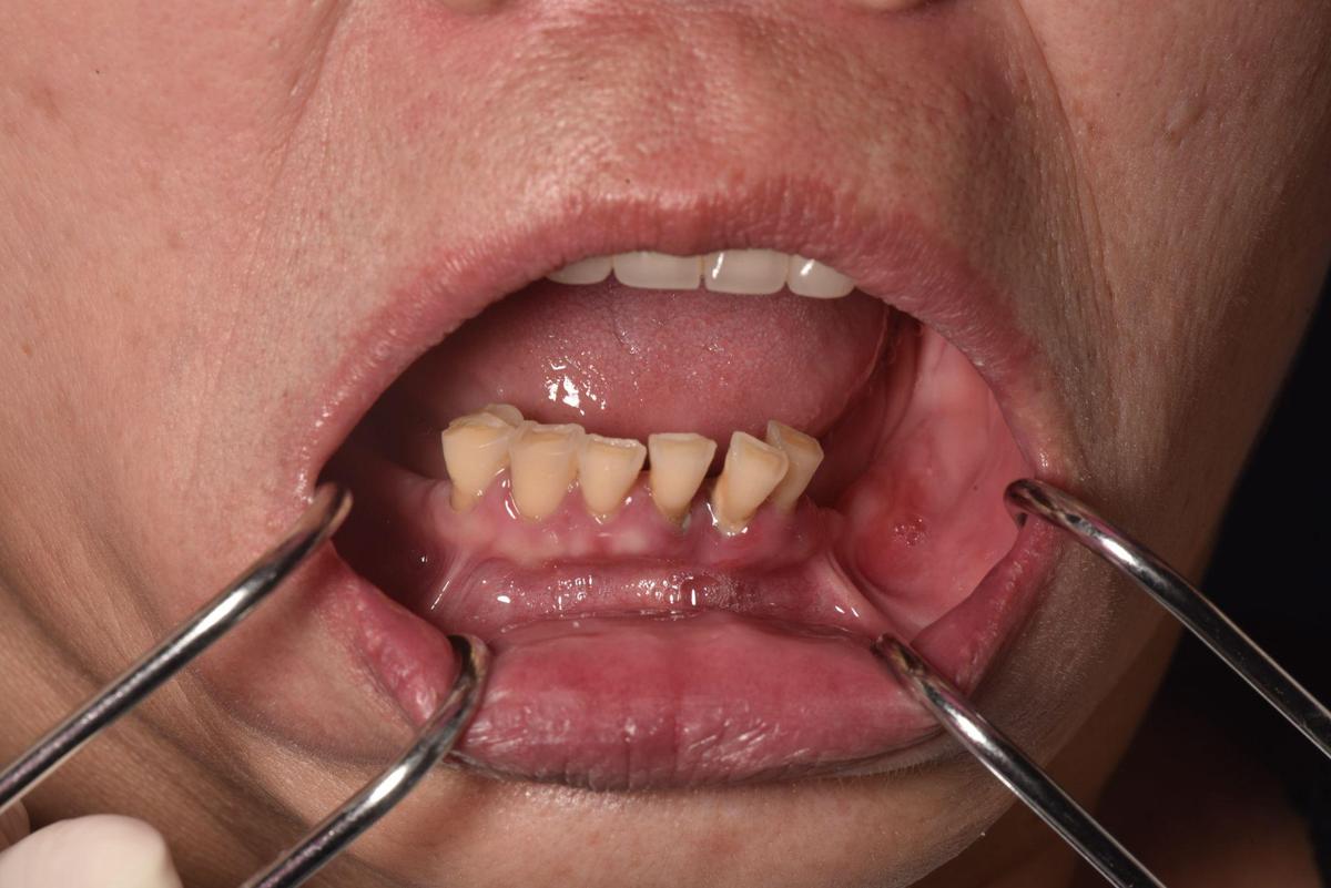 Hình: Cô Phan Thị Mỹ (Việt kiều Mỹ) – tình trạng trước điều trị