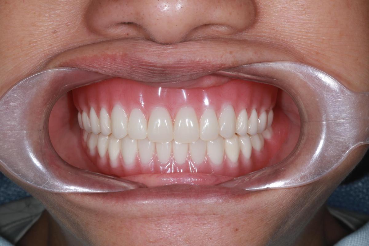 Cô Vân (Việt kiều Mỹ) – quá trình điều trị Hình: Cô Vân (Việt kiều Mỹ) – quá trình điều trị