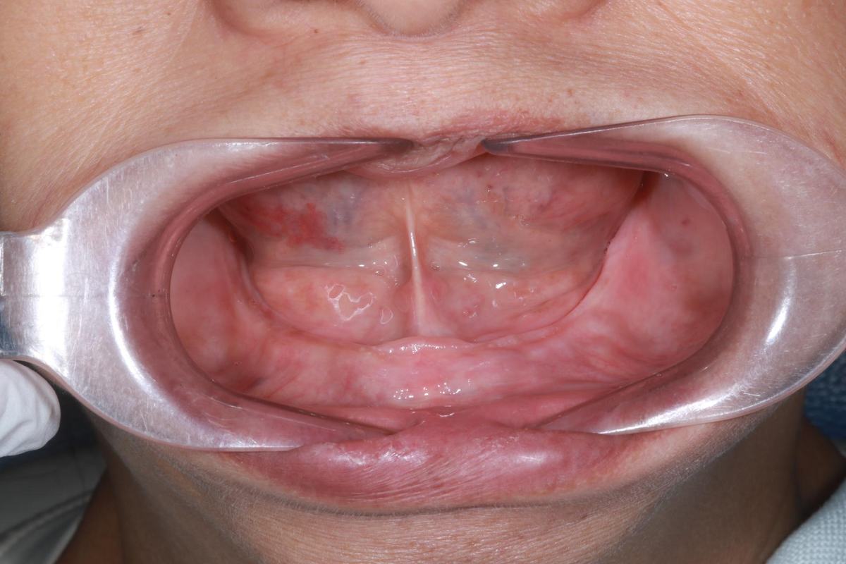 Cô Vân (Việt kiều Mỹ) – tình trạng trước điều trị Hình: Cô Vân (Việt kiều Mỹ) – tình trạng trước điều trị