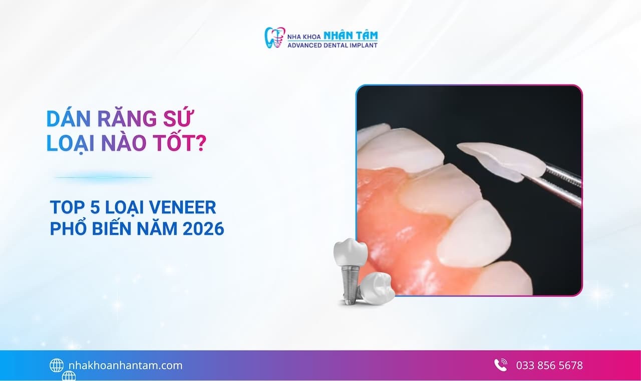 Dán răng sứ loại nào tốt? Top 5 loại Veneer phổ biến năm 2026