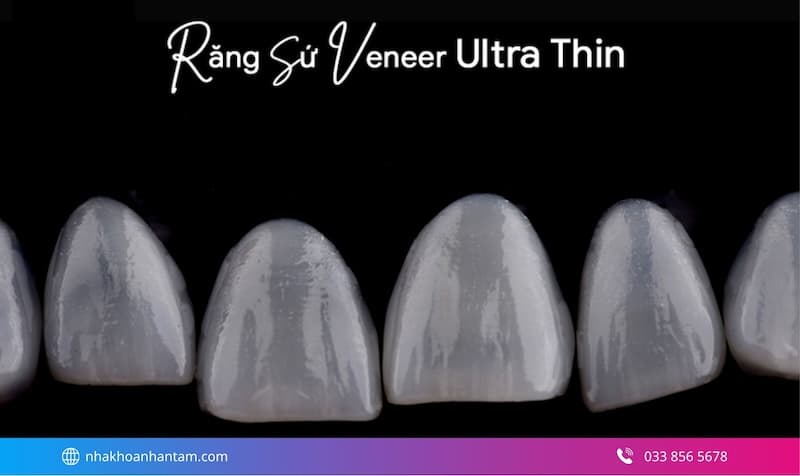 lựa chọn mặt dán sứ phù hợp