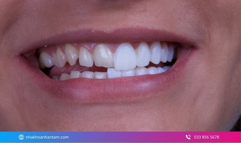 mặt dán sứ nào tốt nhất