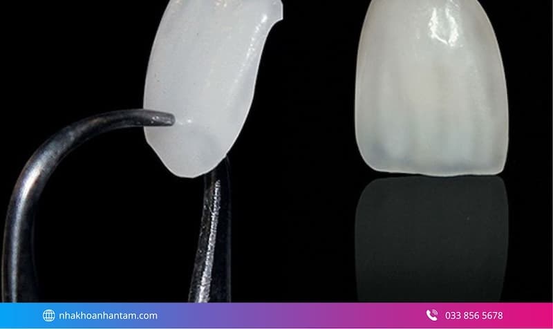 veneer nào tốt nhất hiện nay