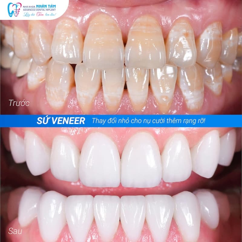 dán sứ veneer có nên làm không