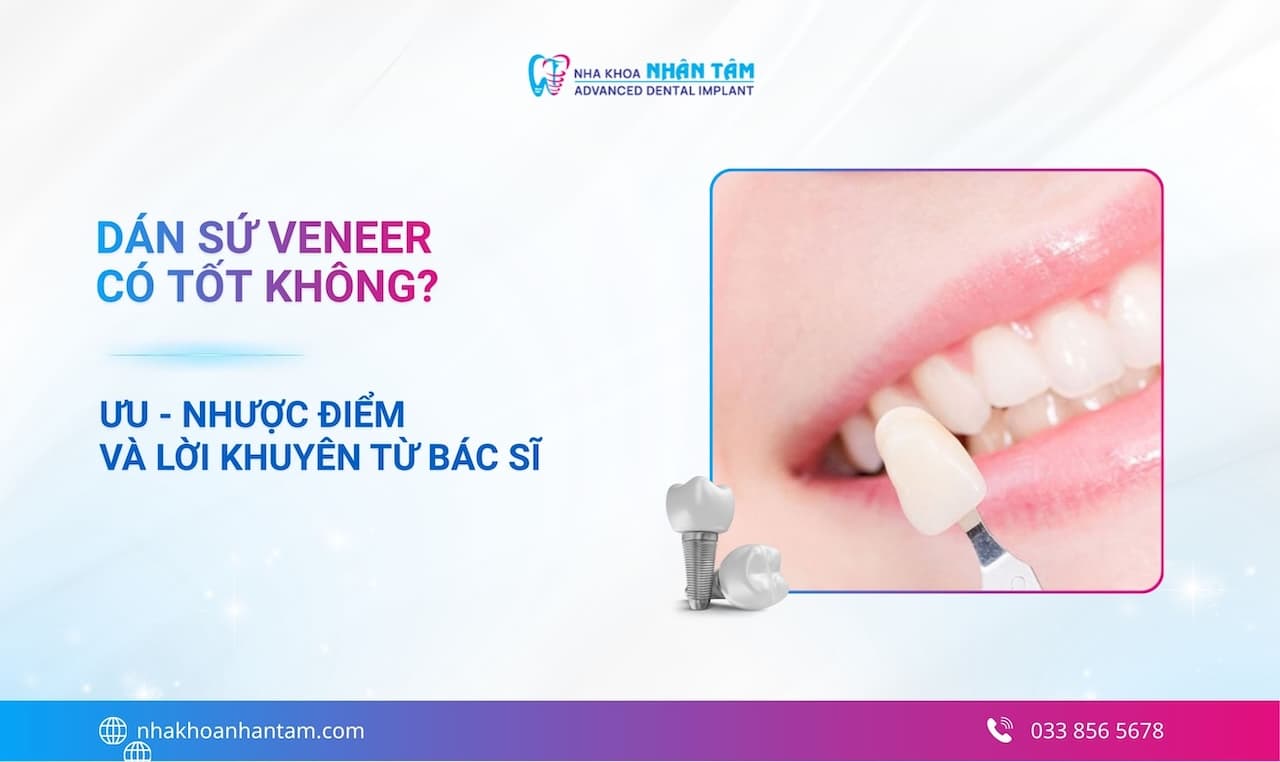 Dán sứ Veneer có tốt không? Ưu - nhược điểm và lời khuyên từ bác sĩ