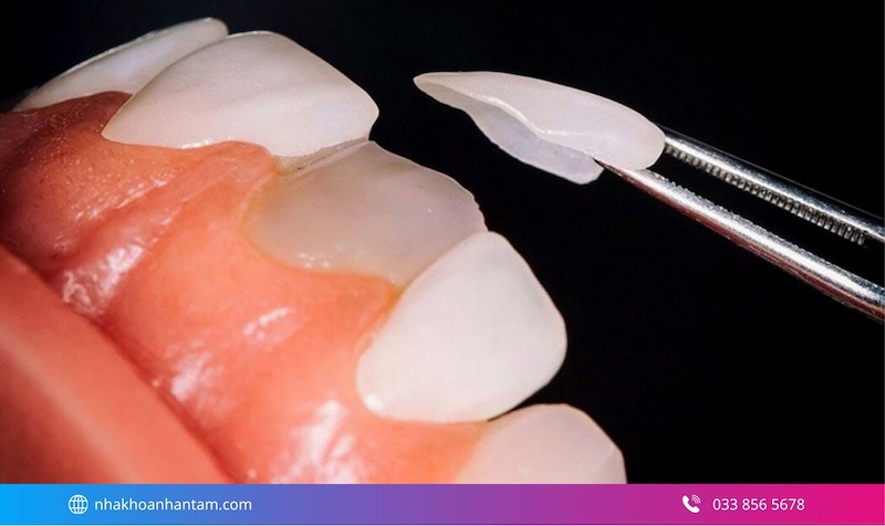 dán veneer có bền không