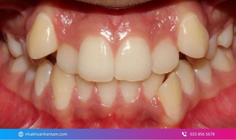 nhược điểm của dán sứ veneer