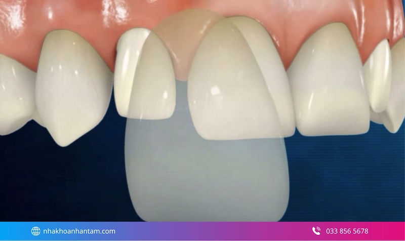 veneer có giữ được lâu không