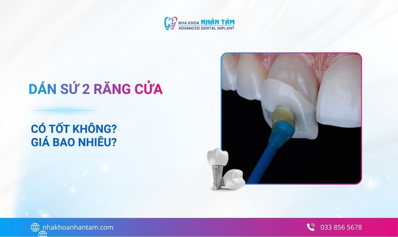 Dán sứ 2 răng cửa có tốt không? Giá bao nhiêu?