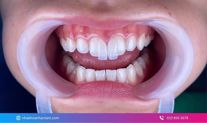 dán sứ veneer 2 răng cửa
