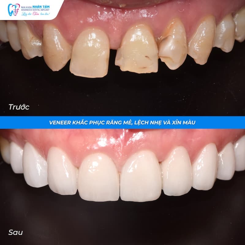 dán veneer răng cửa