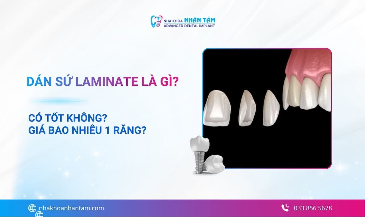 Dán sứ Laminate là gì? Có tốt không? Giá bao nhiêu 1 răng?