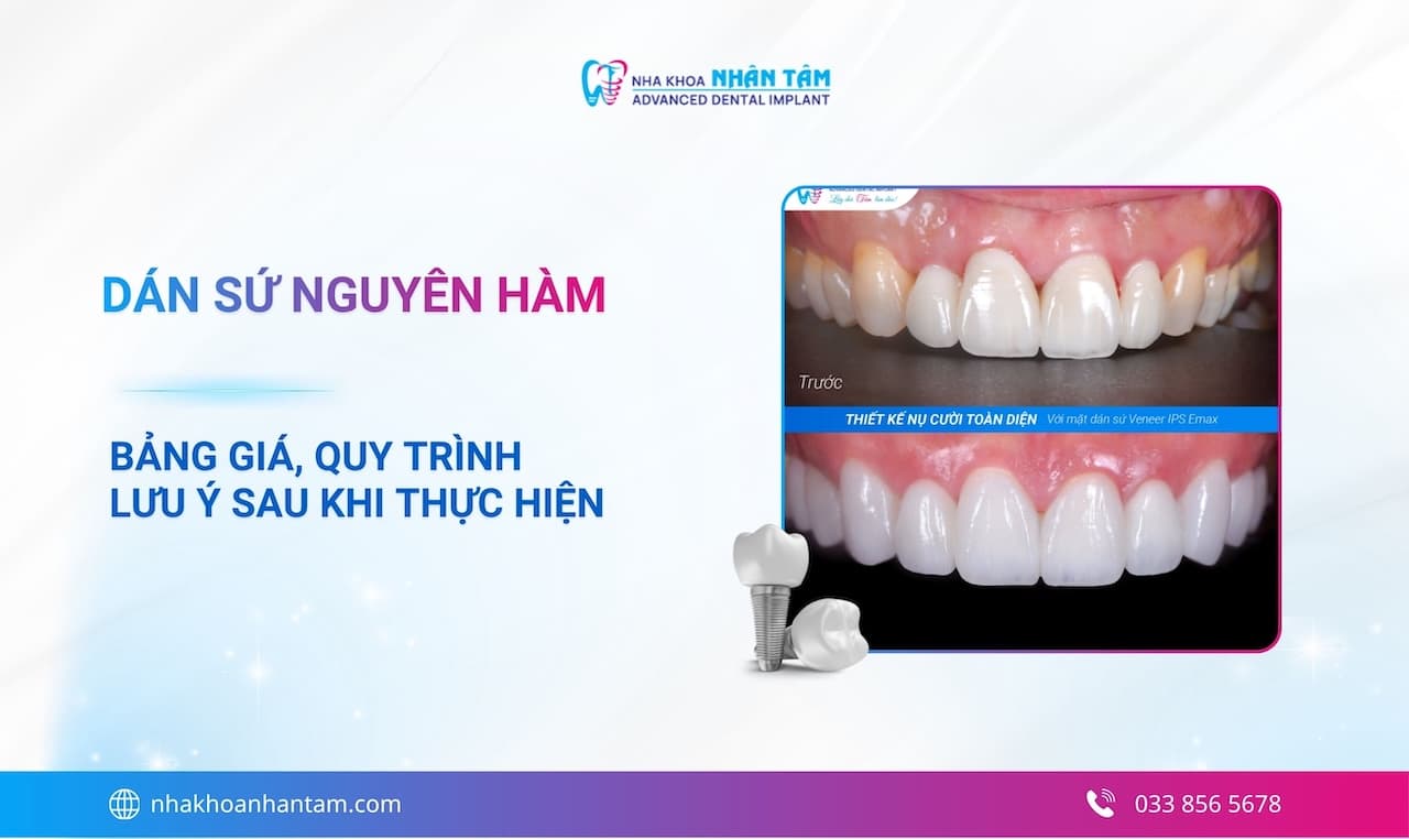Dán sứ nguyên hàm giá bao nhiêu? Bảng giá, quy trình và lưu ý sau khi thực hiện