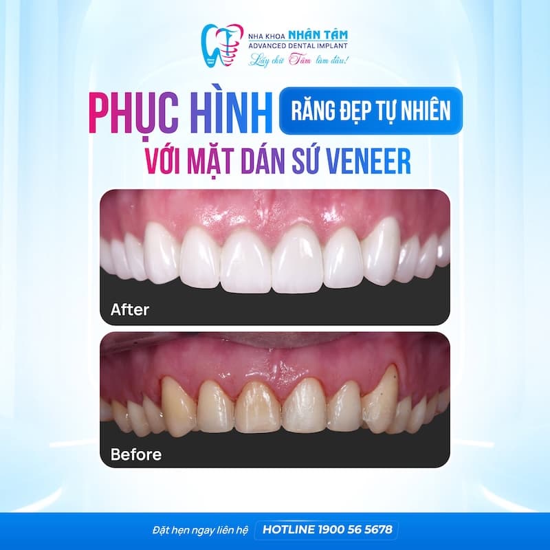 thẩm mỹ răng nguyên hàm bằng veneer