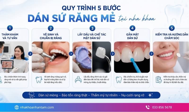 dán sứ cho răng sứt mẻ