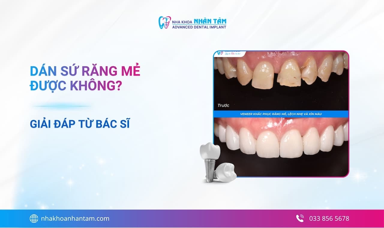 Giải đáp: Dán sứ răng mẻ được không?