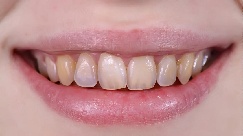 Hình: Dán sứ Veneer phù hợp cho răng bị xỉn màu