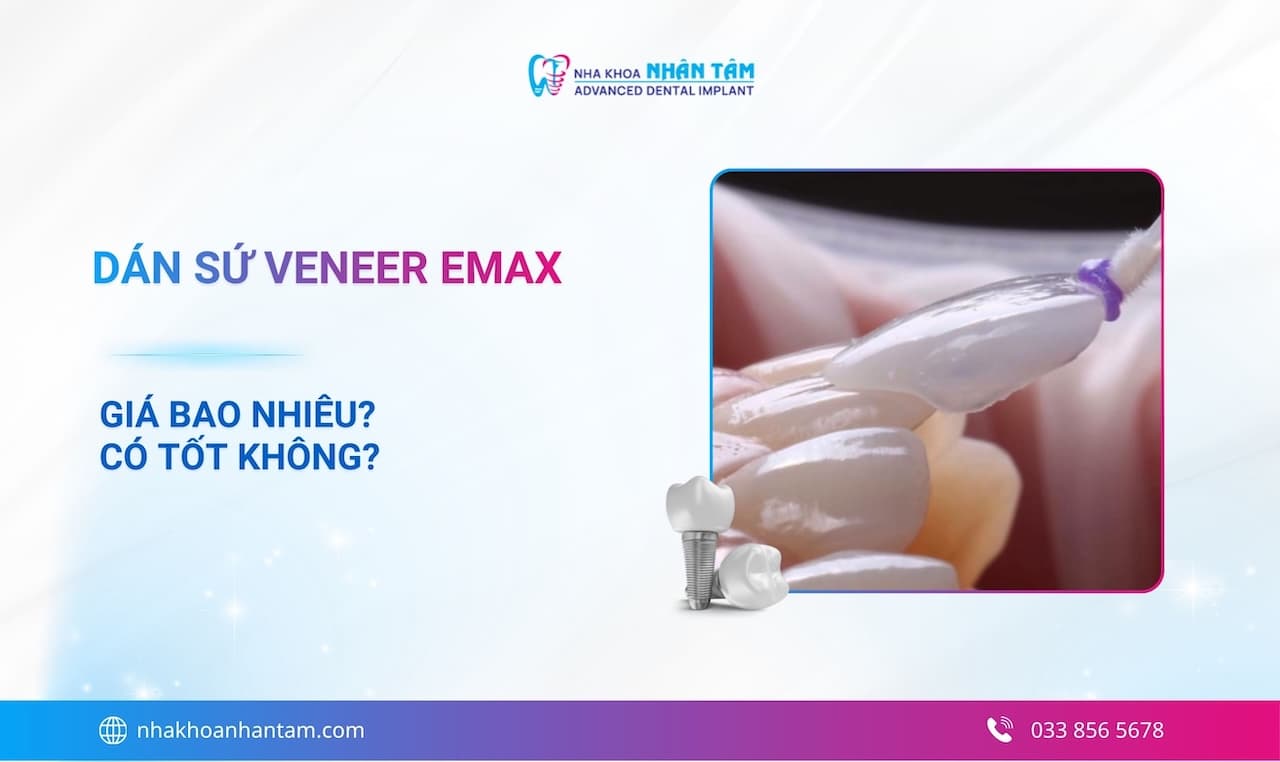 Dán sứ Veneer Emax là gì? Giá bao nhiêu, có tốt không?