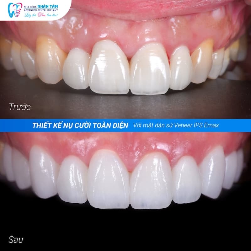 ưu điểm veneer emax