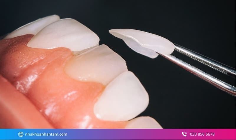dán sứ veneer bao nhiêu tiền