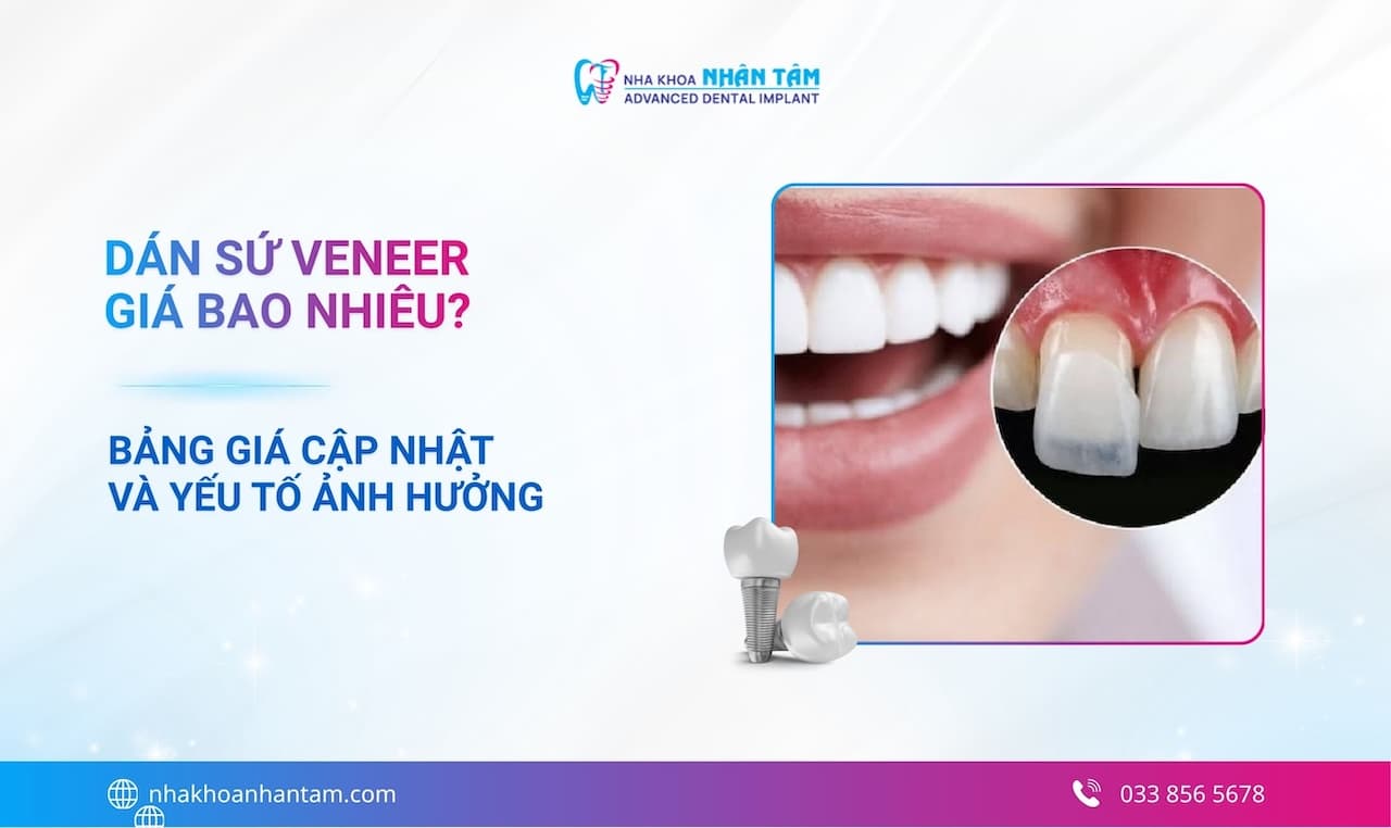 Hình: Dán sứ Veneer giá bao nhiêu? Bảng giá cập nhật và yếu tố ảnh hưởng