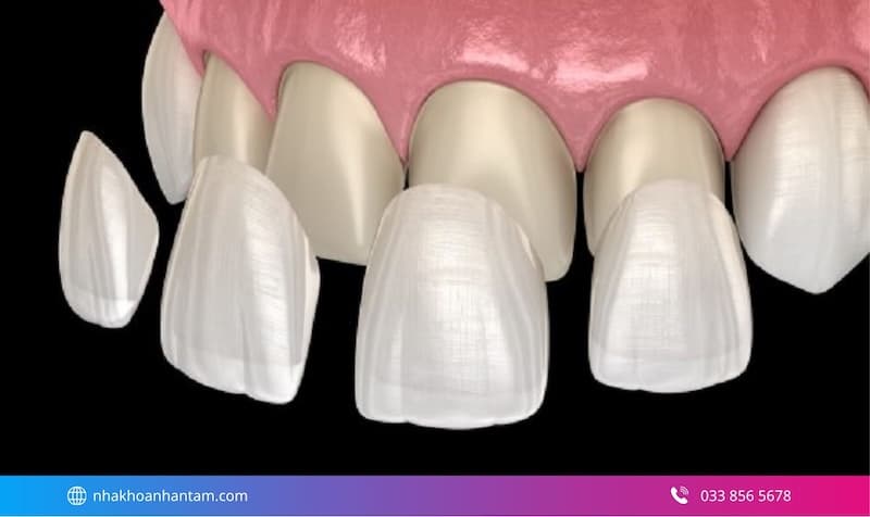 làm veneer giá bao nhiêu