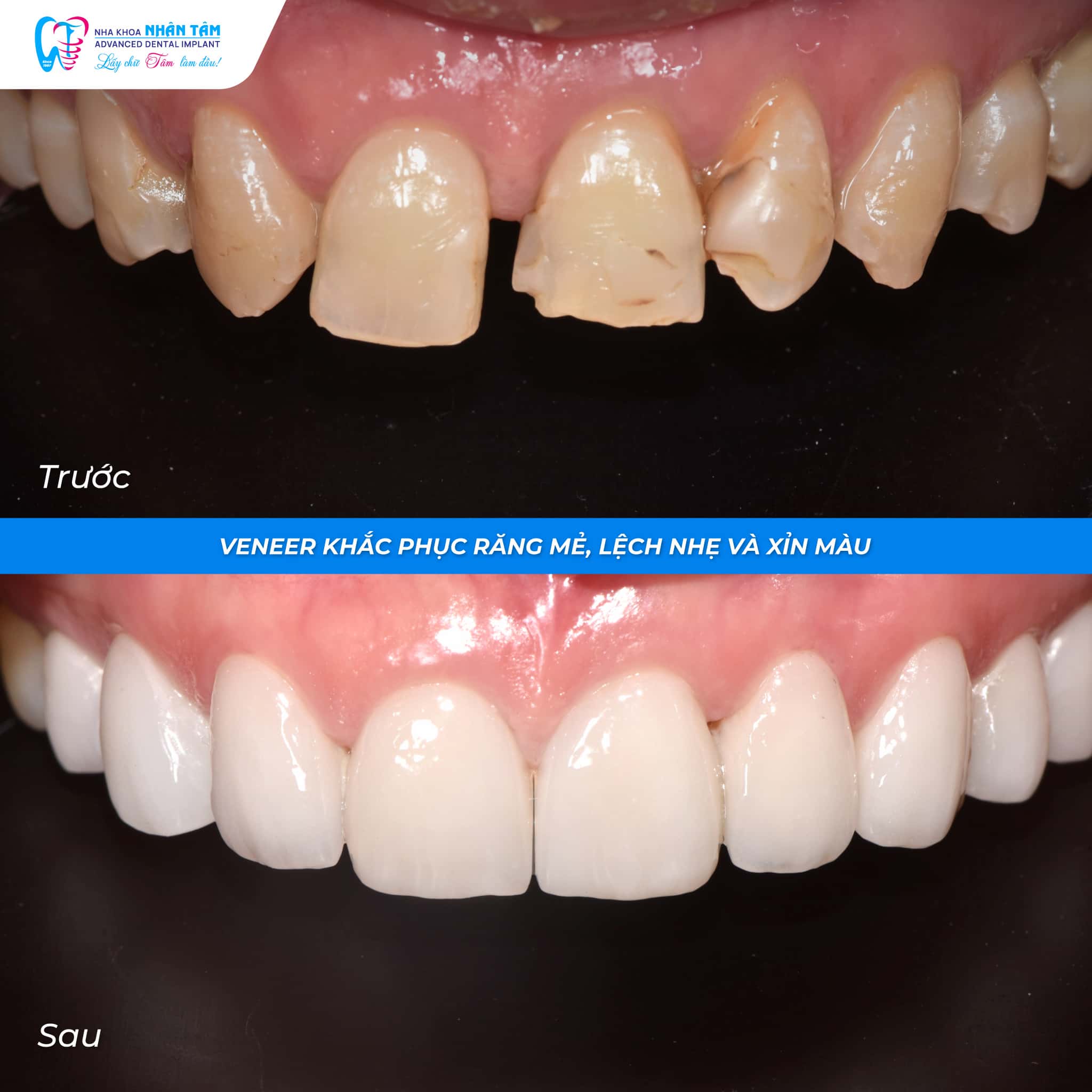Dán sứ Veneer được chỉ định cho các trường hợp răng có khuyết điểm nhẹ về màu sắc hoặc hình dáng Hình: Dán sứ Veneer được chỉ định cho các trường hợp răng có khuyết điểm nhẹ về màu sắc hoặc hình dáng