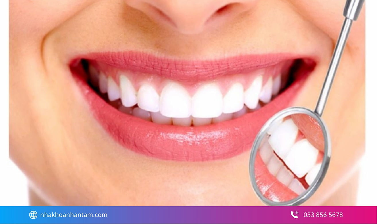 Dán Veneer hỗ trợ cải thiện thẩm mỹ khi cười và giao tiếp Hình: Dán Veneer hỗ trợ cải thiện thẩm mỹ khi cười và giao tiếp
