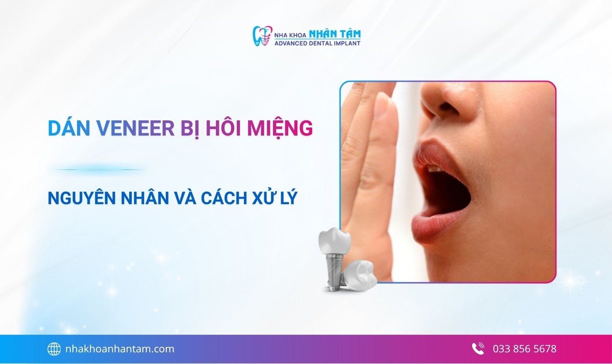 Dán Veneer bị hôi miệng: Nguyên nhân và cách xử lý