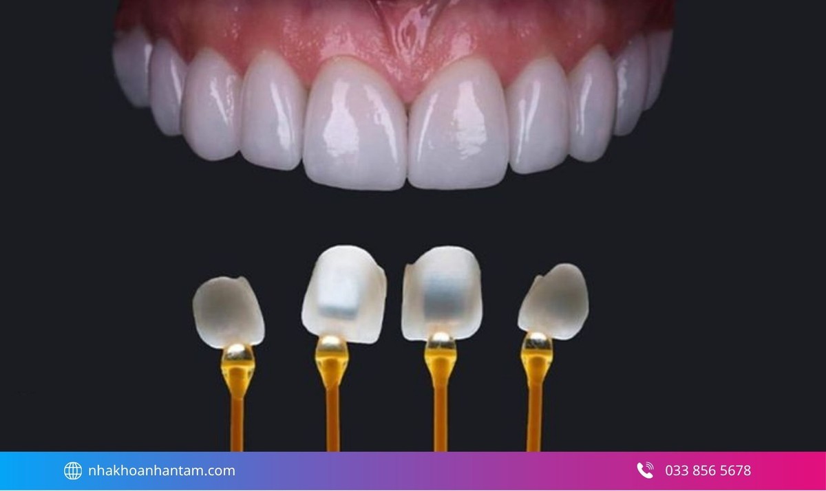 Dán veneer sử dụng một lớp vật liệu mỏng gắn lên mặt ngoài của răng Hình: Dán veneer sử dụng một lớp vật liệu mỏng gắn lên mặt ngoài của răng