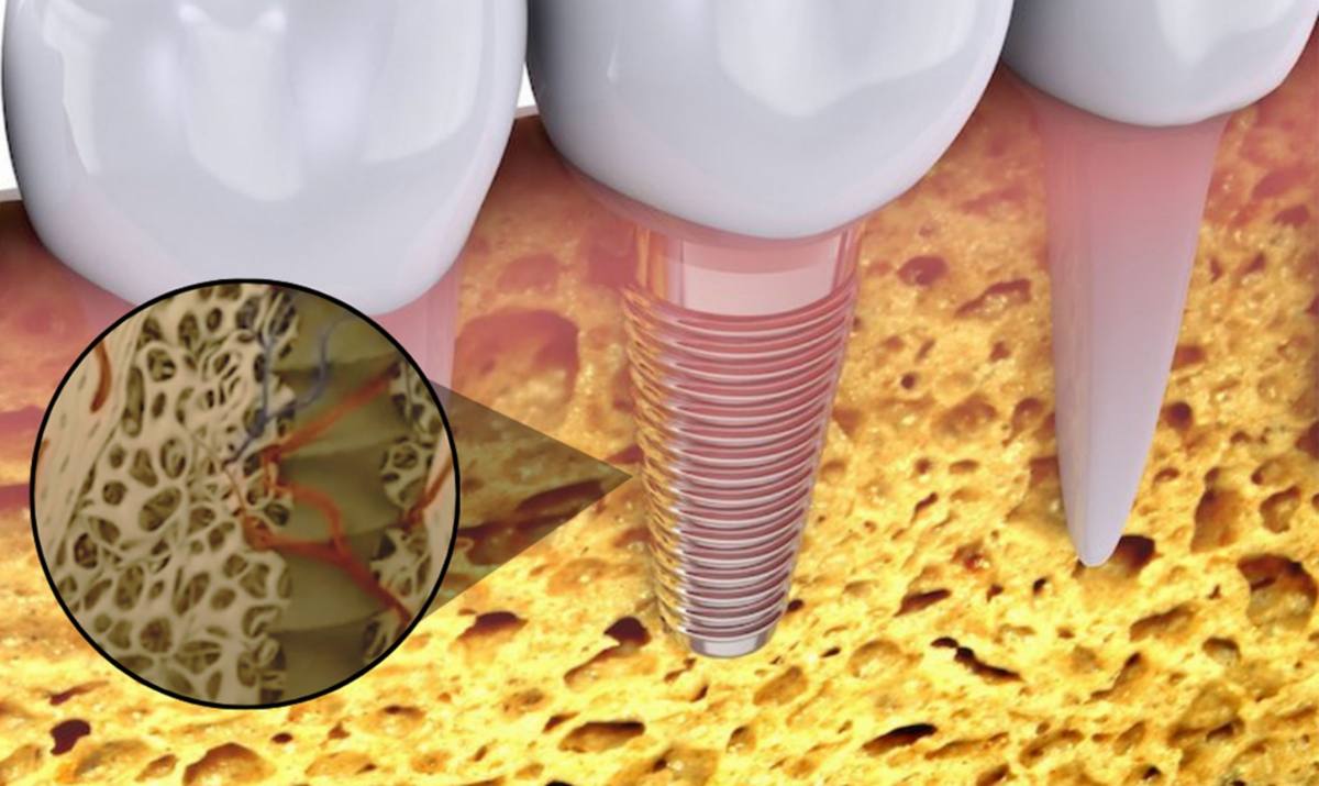 Hình: Đào thải Implant là tình trạng trụ không thể tích hợp vào xương hàm