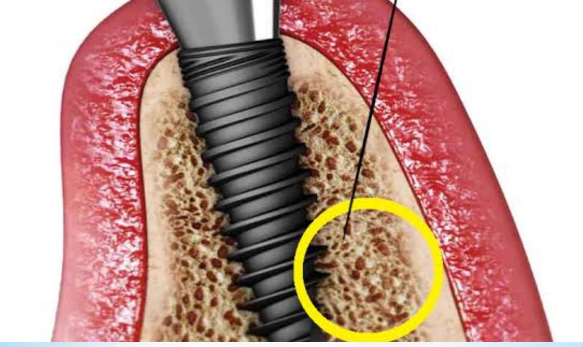 Hình: Sự khác biệt giữa thời điểm phát sinh đào thải sớm và đào thải muộn