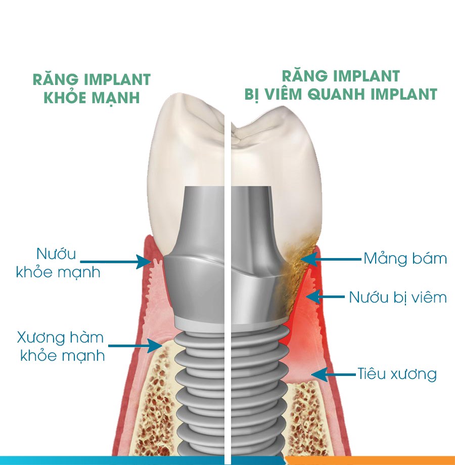 Hình: Dấu hiệu nhận biết trụ implant bị đào thải