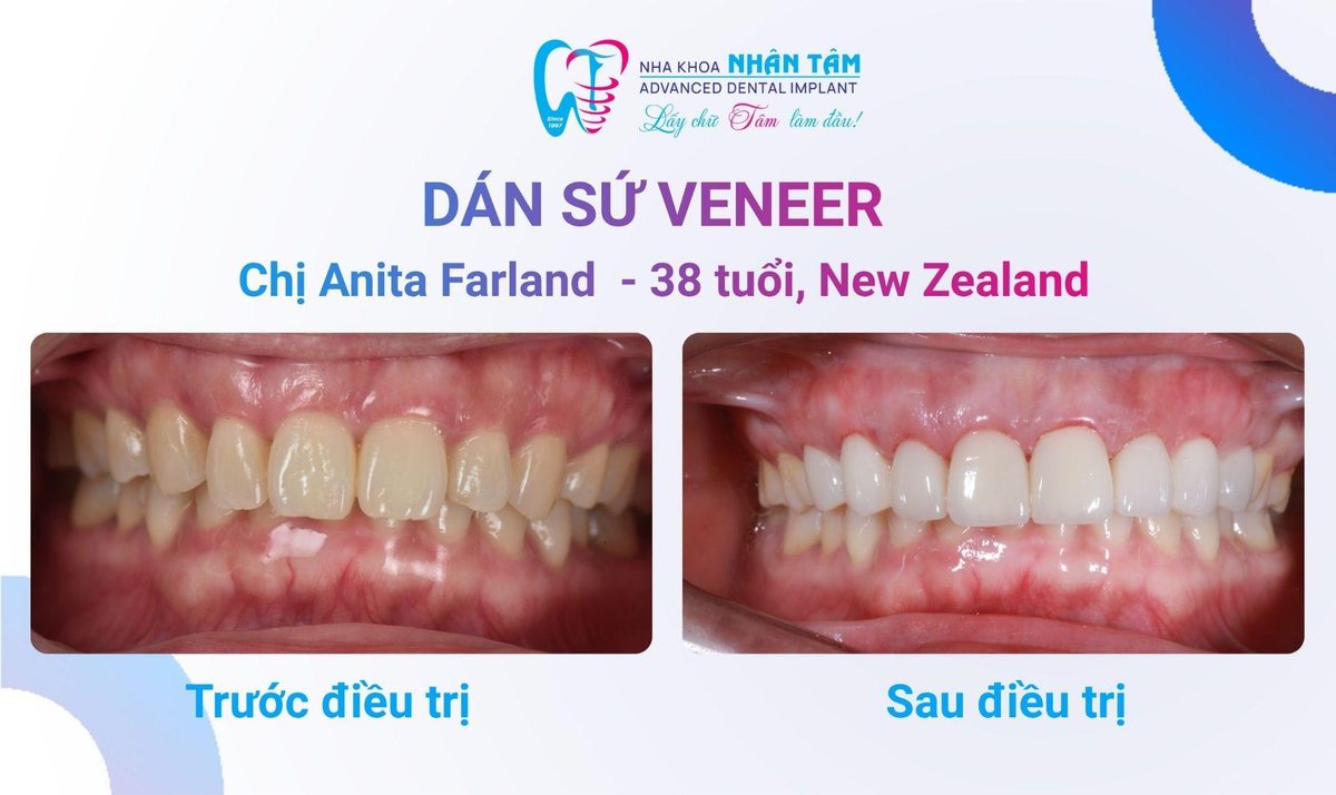 Chị Anita Farland (New Zealand) – Câu chuyện khách hàng tại Nha khoa Nhân Tâm Hình: Chị Anita Farland (New Zealand) – Câu chuyện khách hàng tại Nha khoa Nhân Tâm