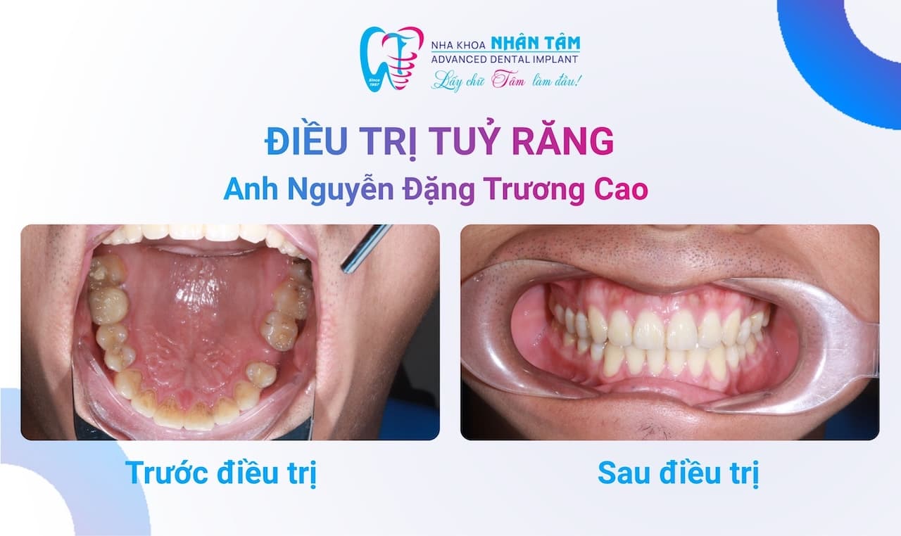 Điều trị tủy răng nhẹ nhàng – Hành trình vượt qua nỗi sợ của anh Trương Cao Điều trị tủy răng nhẹ nhàng – Hành trình vượt qua nỗi sợ của anh Trương Cao